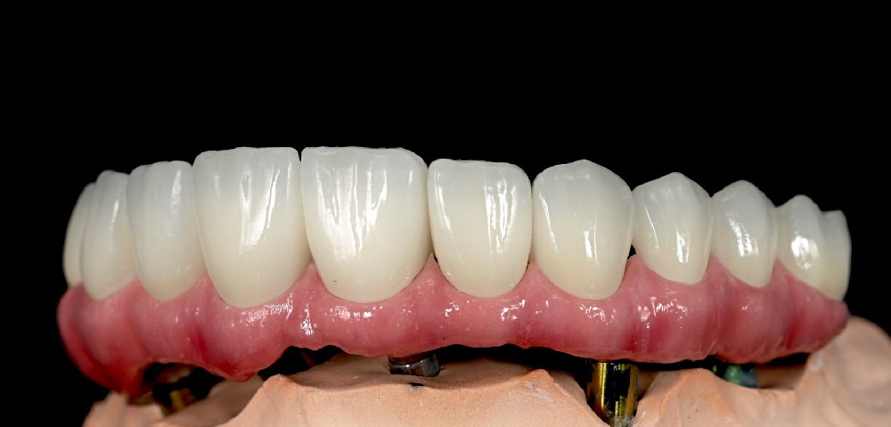 Crown and Bridge Outsourcing Chinese Dental Lab