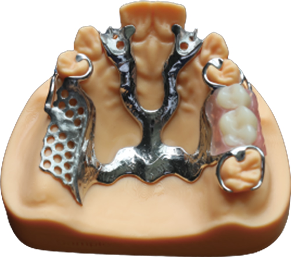 3D Laser Printing Precision Bracket Alloy Framework for Dentures